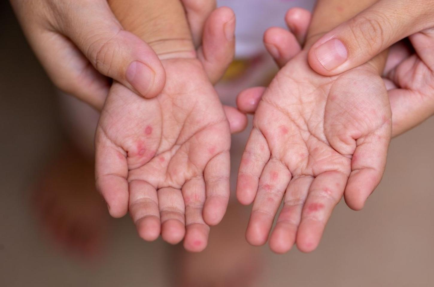 Casos de síndrome mão-pé-boca confirmados em escola municipal de Macapá