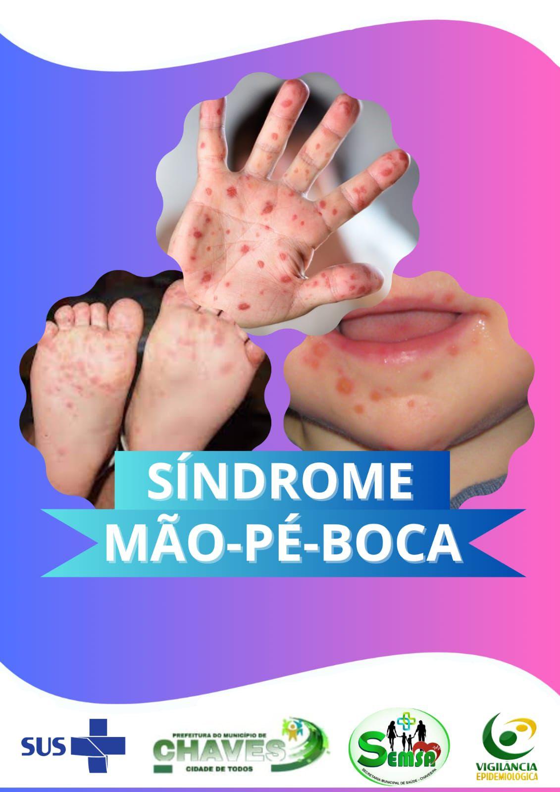 Município de Chaves registra casos da síndrome mão pé boca